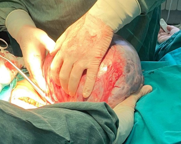 Киста по голяма от волейболна топка отстраниха лекарите от акушер гинекологичното отделение