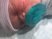 Направиха 13 шева на лицето на бебе след секцио