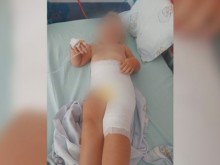 Дезинфектант причини тежко изгаряне на 2-годишно дете