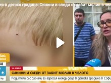 Агресия в детска градина в София: Синини и следи от забит молив в челото