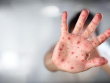 СЗО с важно предупреждение за маймунската шарка