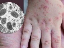 СЗО призовава за спешни действия срещу маймунската шарка