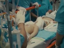 Разделиха успешно 3-годишни сиамски близнаци