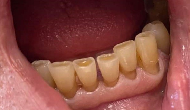 Младеж загуби зъб при сбиване в дупнишко училище