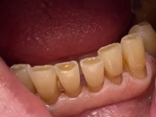 Младеж загуби зъб при сбиване в дупнишко училище