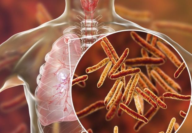 Случаите на туберкулоза са се увеличили за първи път от години