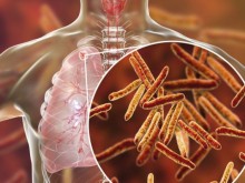 Случаите на туберкулоза са се увеличили за първи път от години