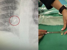 Бургаски лекари спасиха дете със заседнал в трахеята зъб