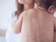 Броят на заболелите от скарлатина в Пловдив се увеличава