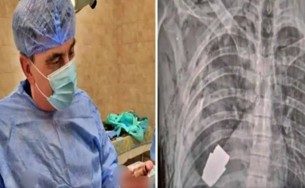 Военни лекари в Украйна са извадили взривателя на ръчна граната от гърдите