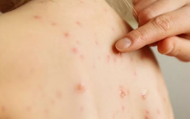 Нов връх на случаите на заразени с варицела Почти 1500