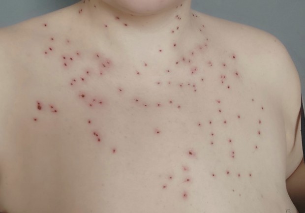 Жена пострада жестоко след процедура за премахване на кожни образувания