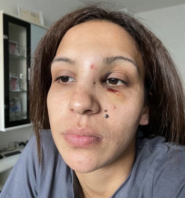 "Счупен нос, фрактура на черепа, синини": Жена твърди, че е бита от бившия й съпруг пред детето им