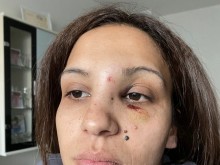 "Счупен нос, фрактура на черепа, синини": Жена твърди, че е бита от бившия й съпруг пред детето им