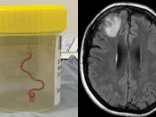 За първи път в света: намериха паразитен червей в мозъка на жена