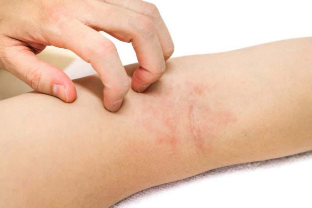 Новата терапия която лекува атопичен дерматит е първата по рода
