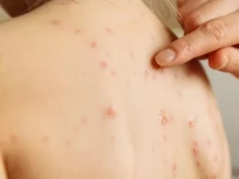 Има ли опасност от епидемия от морбили, говори проф. Кунчев