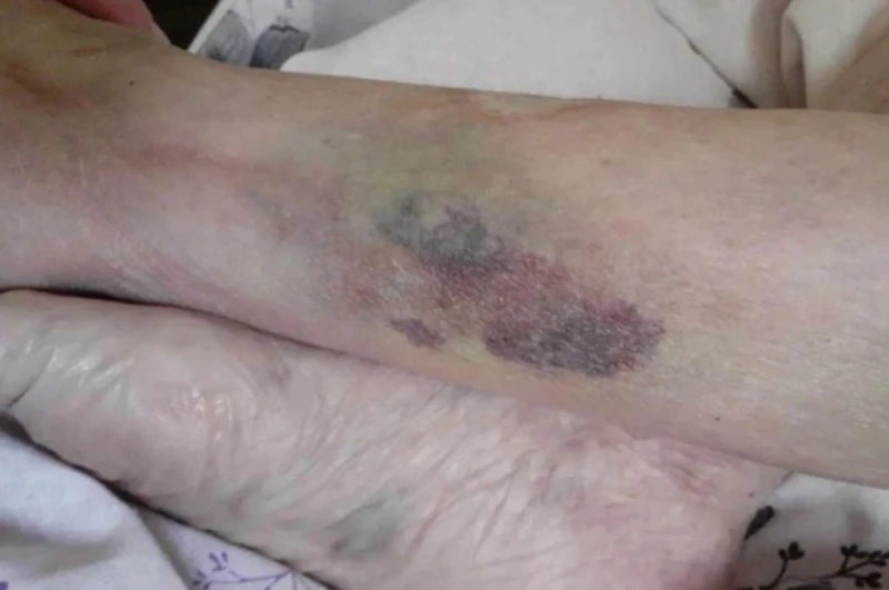 "Медицински надзор" потвърди, че 104-годишната жена, изписана от болницата във Видин със синини е била връзвана