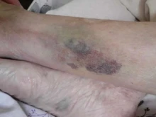 "Медицински надзор" потвърди, че 104-годишната жена, изписана от болницата във Видин със синини е била връзвана