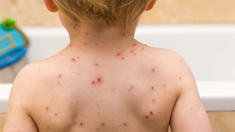 30 случая на варицела са регистрирани в Смолянско за седмица