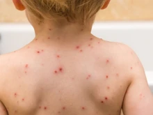 30 случая на варицела са регистрирани в Смолянско за седмица