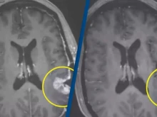 Забележителен пробив при рака показa как мозъчен тумор на жена почти изчезна само за пет дни