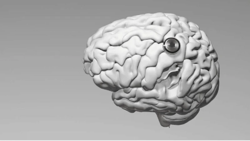 Първият пациент на Neuralink с чип в мозъка иска ъпгрейд