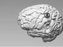 Първият пациент на Neuralink с чип в мозъка иска ъпгрейд