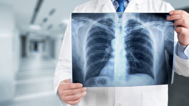 TD Седмица на отворените врати за безплатни прегледи за туберкулоза ще