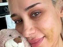 Ергенка се появи с огромна синина на лицето