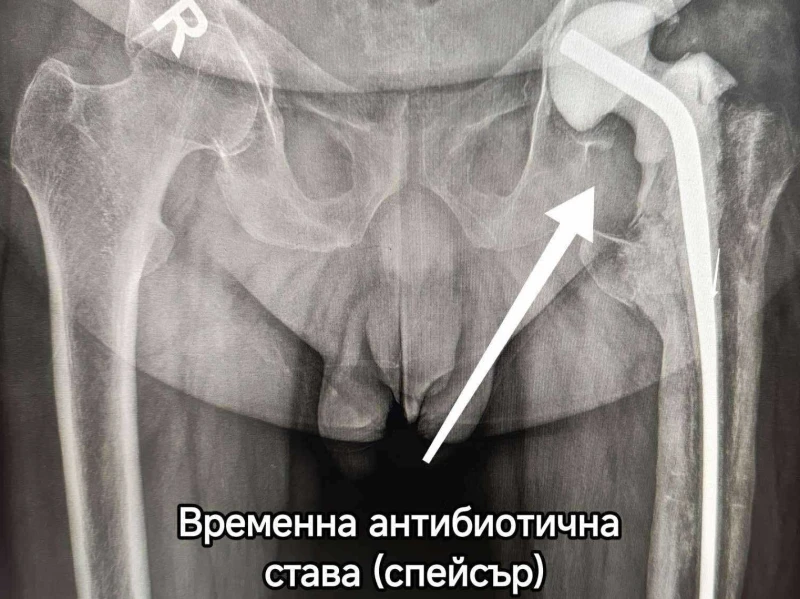 В Пловдив спасиха крака на пациент с тежка костна инфекция