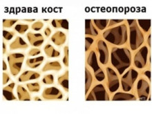 РЗИ: Движете се и приемайте витамини, протеини и калций, за да избегнете остеопороза