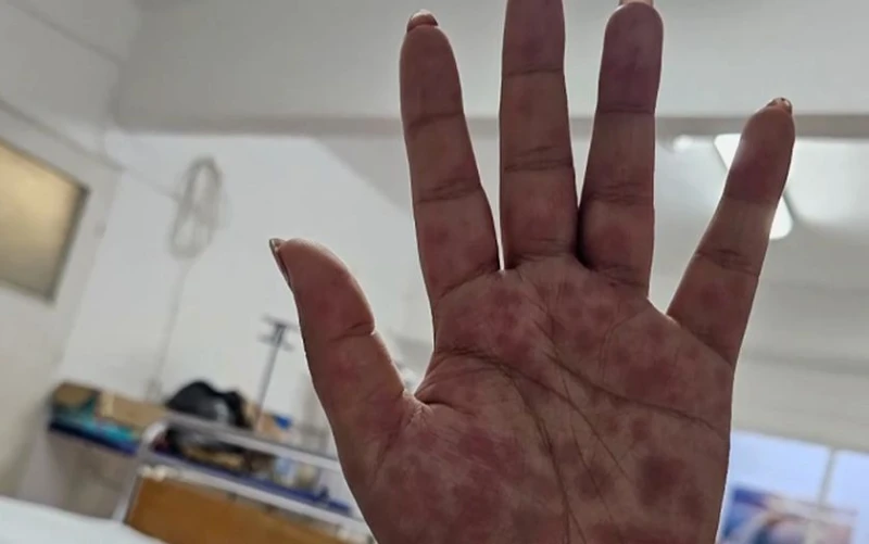 Опасна добавка за отслабване прати 59 българки в болница! 10 са били с опасност за живота - получили обрив по цялото тяло и органите!