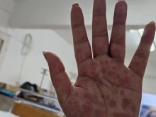 Опасна добавка за отслабване прати 59 българки в болница! 10 са били с опасност за живота - получили обрив по цялото тяло и органите!