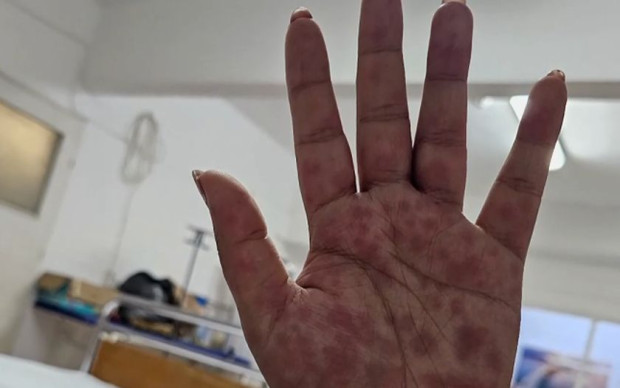 Опасна добавка за отслабване прати 59 българки в болница, 10 са били с опасност за живота