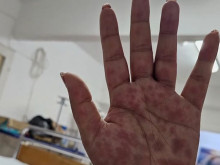 Опасна добавка за отслабване прати 59 българки в болница, 10 са били с опасност за живота