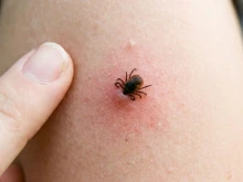 Педиатър: Да имаш кърлеж по същество не е спешна ситуация