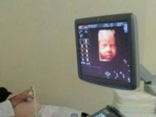 Откриха мозъчна аномалия на бебе в утробата на майката
