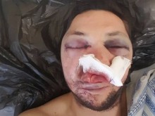 Жестоко пребиха журналист-кандидат за общински съветник