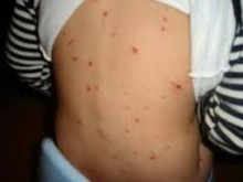 Десетки деца от Пловдив пипнаха варицела за три дни