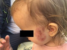 Уволниха медицинска сестра заради нахапаното дете в ясла 