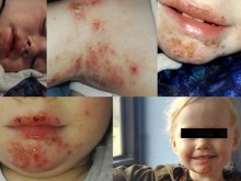 Майка: Дъщеря ми беше изядена жива от кожна инфекция
