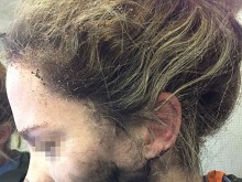 Млада жена пострада, след като слушалките й избухнаха в самолета