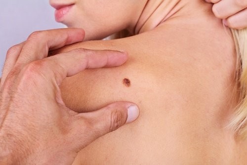 16 от случаите на рак на кожата могат да бъдат