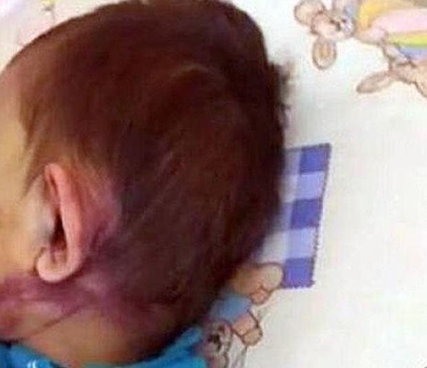 2 годишно момченце е прието за лечение с комоцио и явни
