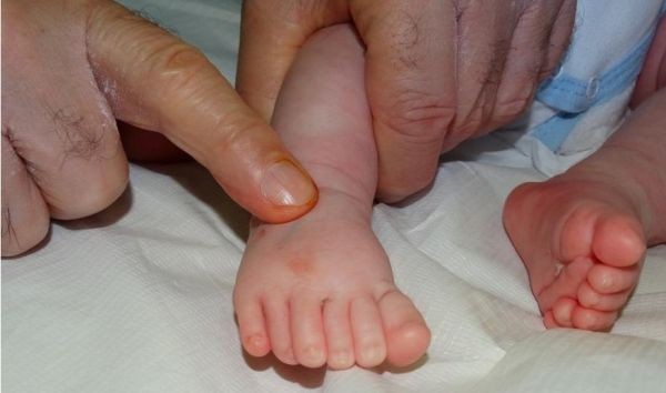 Бебе с шест пръста на всеки крайник бе успешно оперирано