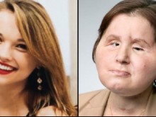 21-годишно момиче е най-младият човек в света с присадено лице
