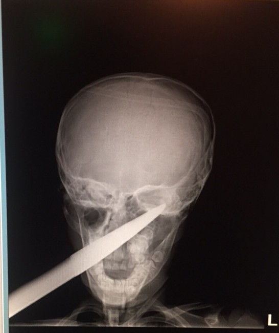 7 годишно момче със забита в главата градинска ножица беше спасено