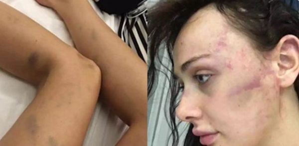 Сръбският модел Таня Дукич е била пребита от приятеля си