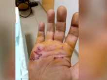 Млад мъж е бил нахапан жестоко от питбул във Варна